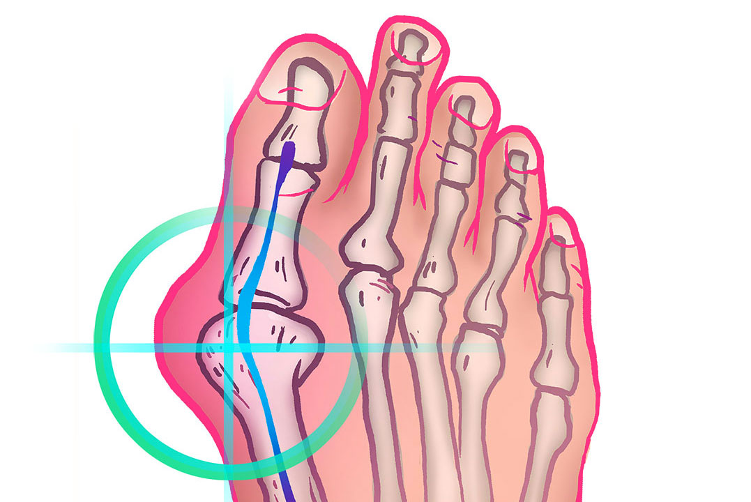 Op Ration Du Pied Hallux Valgus Nice